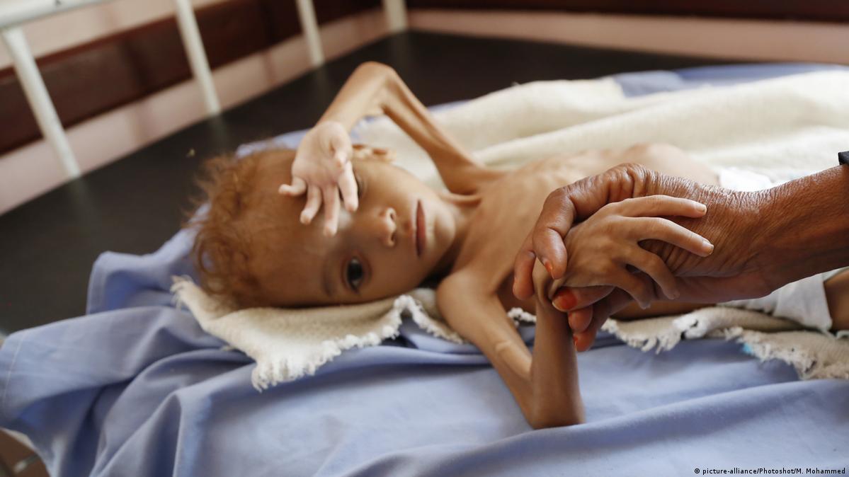 Yemen’de savaşın maduru çocuklar